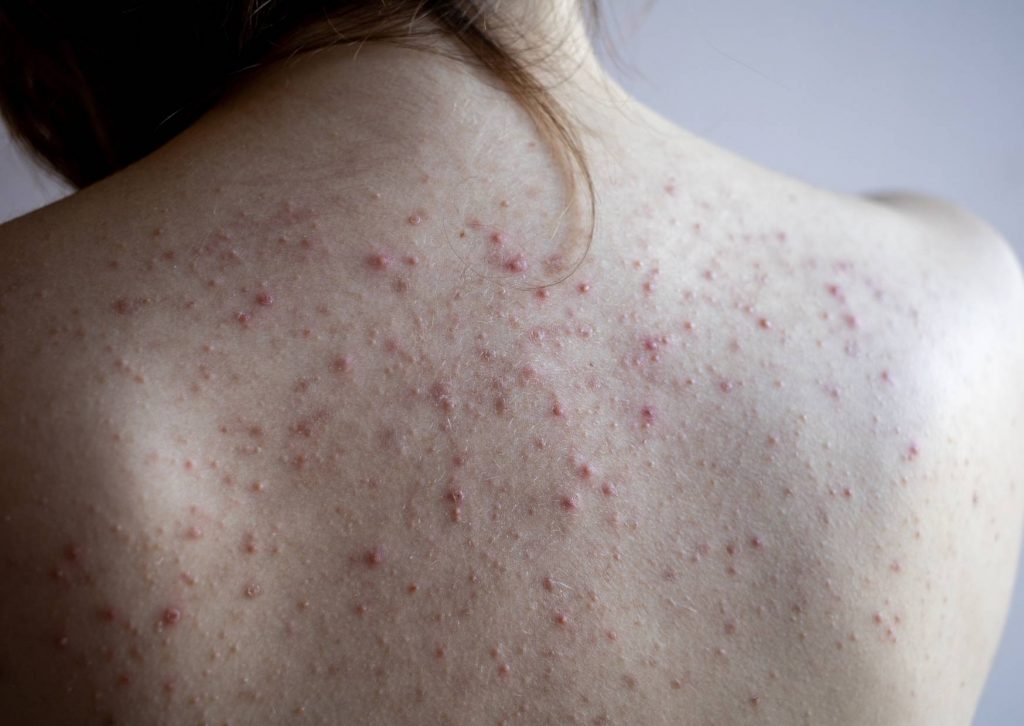 acne du dos
