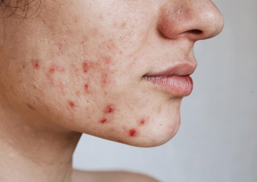 acne du menton