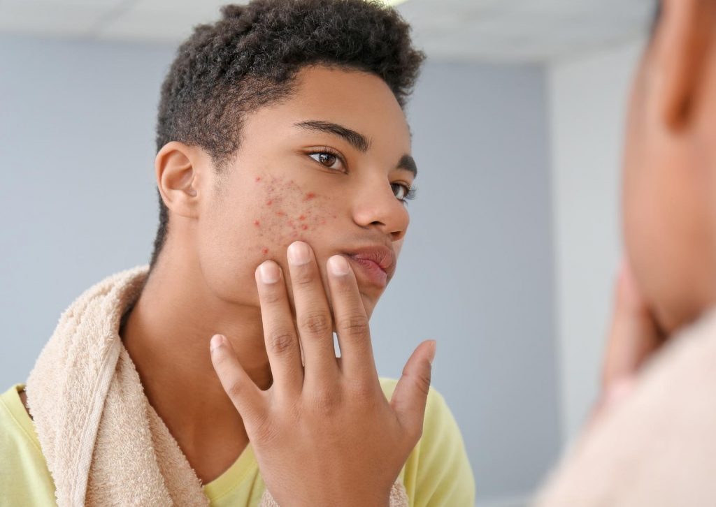 acne et rasage