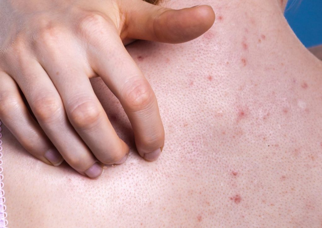 acne_corps (1)