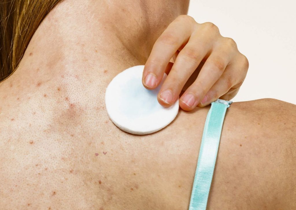 acne_corps