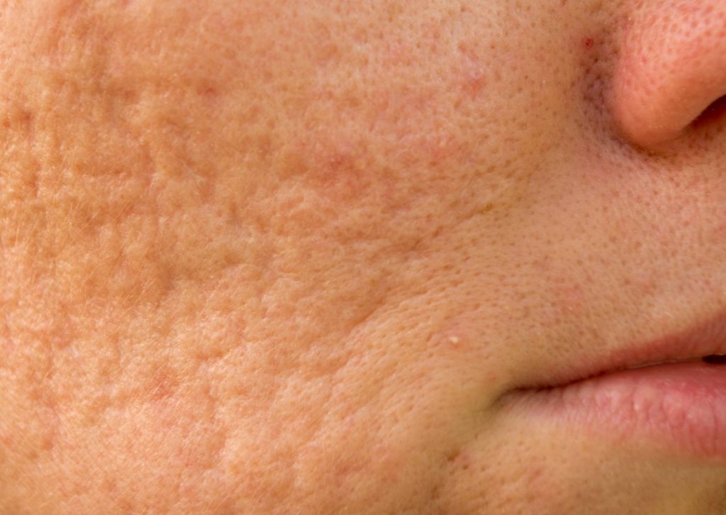 cicatrices d'acne