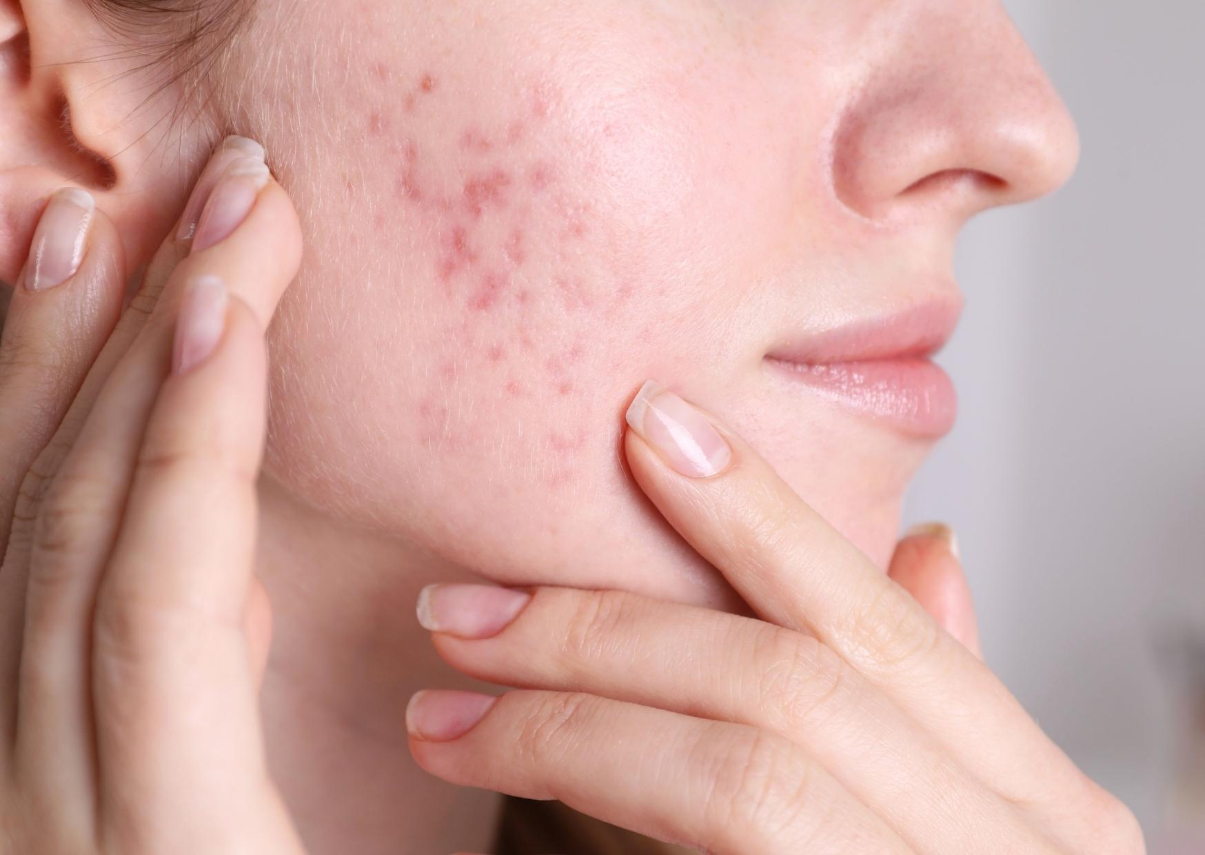 huiles essentielles contre l'acne (1) acne hormonale