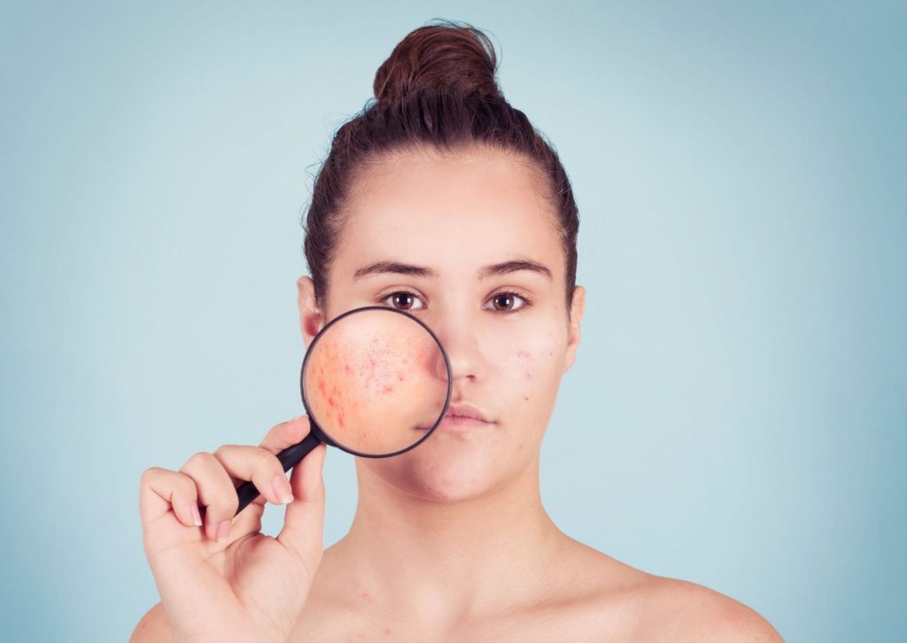 les differents types d acne