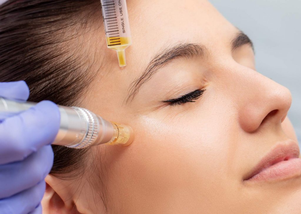 micro needling acne